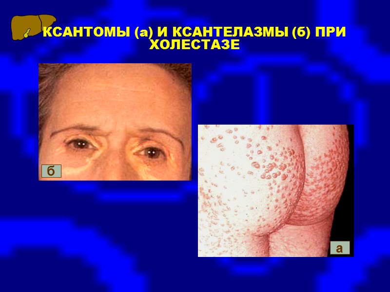 Клиническая картина хронического вирусного гепатита Может иметь непрерывно рецидивирующее течение или протекать с чередованием