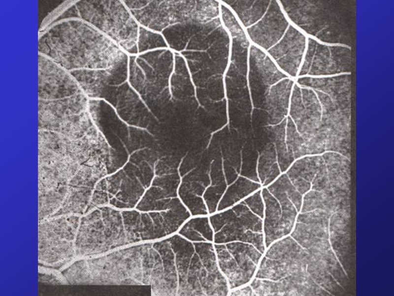 II. Витреоретинальные и экваториальные дистрофии (х-хромосомный юношеский ретиношизис, старческий ретиношизис, решетчатая дистрофия, «след улитки»,