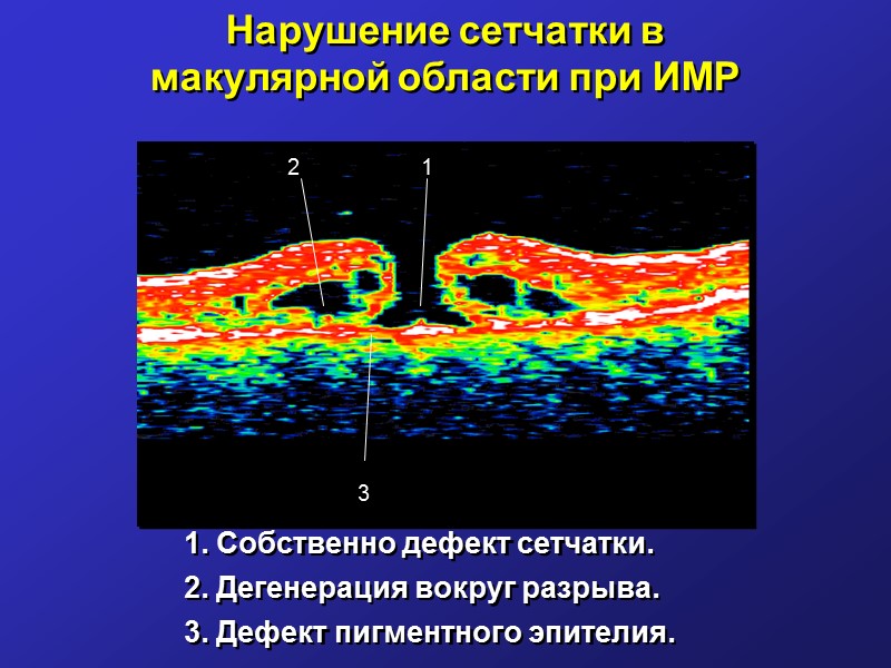 Офтальмоскопическая картина сквозного макулярного разрыва