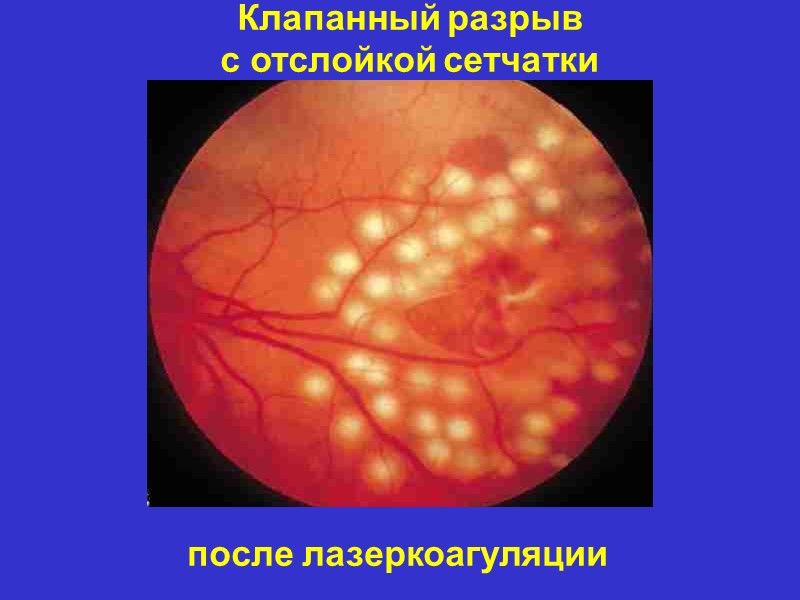 Клапанный разрыв с отслойкой сетчатки      после лазеркоагуляции