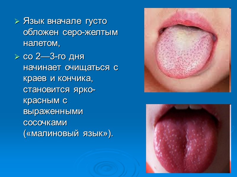 Возбудитель -гемолитический  стрептококк группы А,  способный продуцировать  экзотоксин (токсин Дика), 