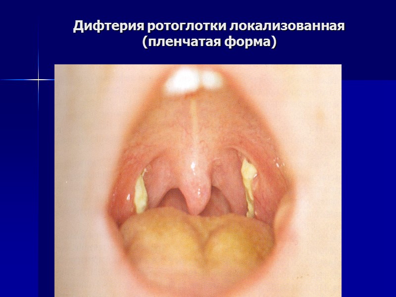 Дифтерия  дыхательных путей  Дифтерия носа- локализованная: катаральная, пленчатая, распространенная (редко), токсическая (очень