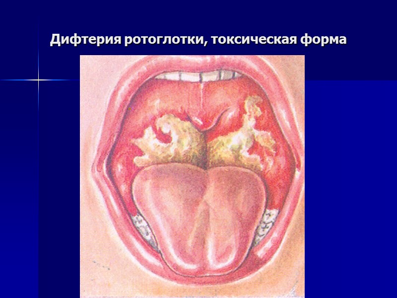 Дифтерия ротоглотки, распространенная форма (налет покрывает миндалины, язычок, небные дужки, заднюю стенку глотки, отека
