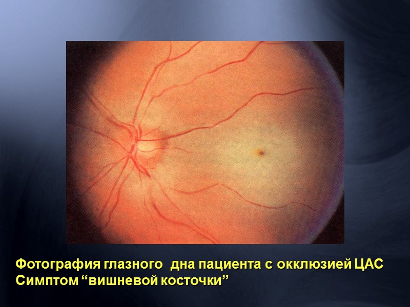 Артериовенозная ф а з а -   расширение вен и капиляров, извитость сосудов,