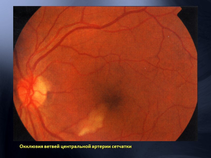 Пролиферативная  диабетическая ретинопатия