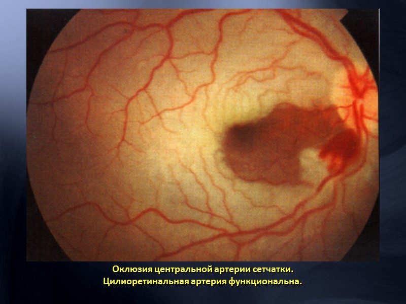 Артериовенозная фаза - множественнные  микроаневризмы в центральных отделах, новообразованные сосуды на диске зрительного