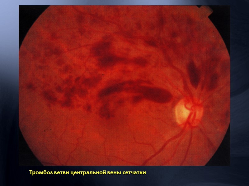 Витреоретинальная хирургия