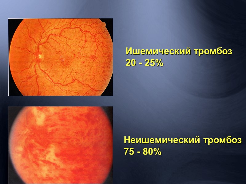 1 рубль, вложенный в ВРХ диабетической ретинопатии экономит  2 рубля.  1 рубль,