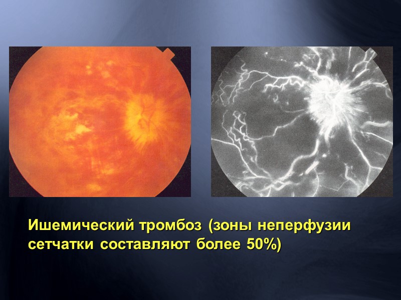 Отслойка сетчатки