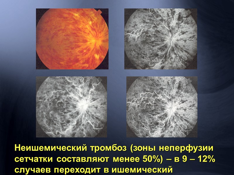 Отслойка сетчатки Первичная отслойка сетчатки (регматогенная) Вторичная отслойка сетчатки  экссудативная –  