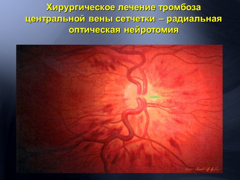 Меанизмы развития первичной  отслойки сетчатки Отслоенное стекловидное тело тянет за край разрыва 