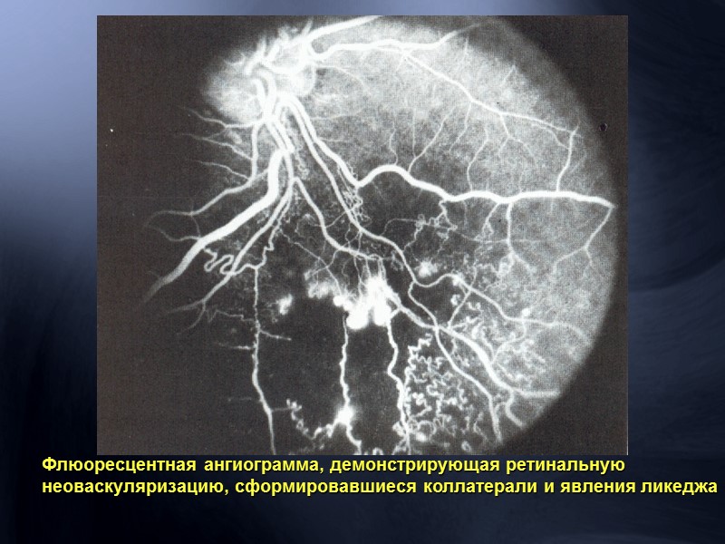 Диагностика отслойки сетчатки Дефект поля зрения  полностью повторяет  контуры отслойки  сетчатки