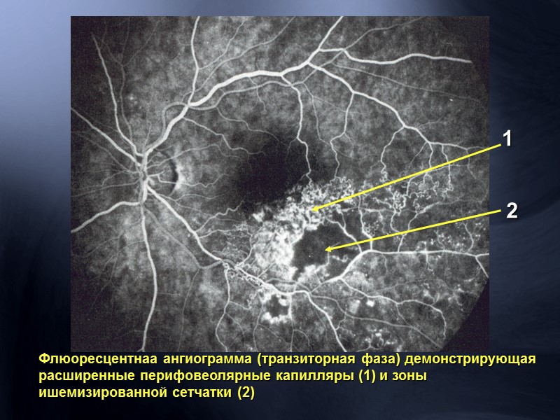 Лечение отслойки сетчатки Цель операции:  сближение сетчатки и хориоидеи в   