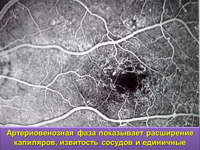 Пролиферативная витреоретинопатия Передняя ПВР Укорочение сетчатки  за счёт контракции  поверхностных мембран.