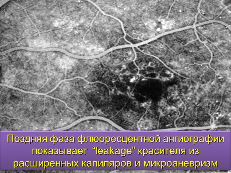 Исходы ПВР:  Прогрессирование отслойки сетчатки Потеря зрения Гипотония Фтизис глазного яблока - раньше