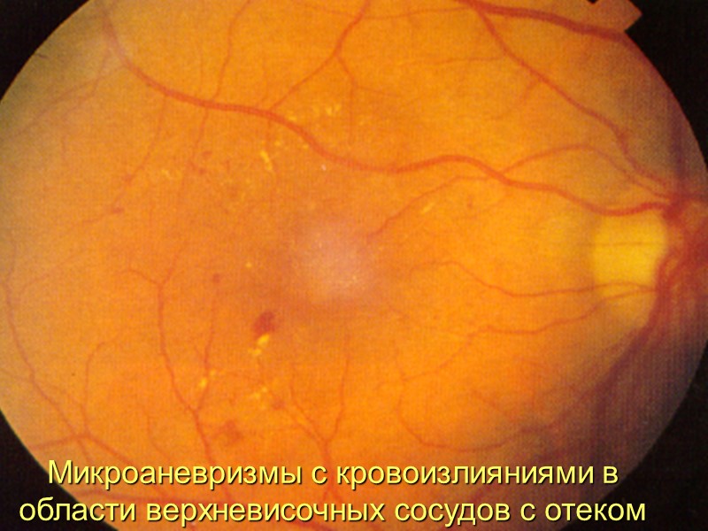 Возрастная макулярная дегенерация – хронический прогрессирующий дистрофический процесс, протекающий с поражением хориокапиллярного слоя, мембраны