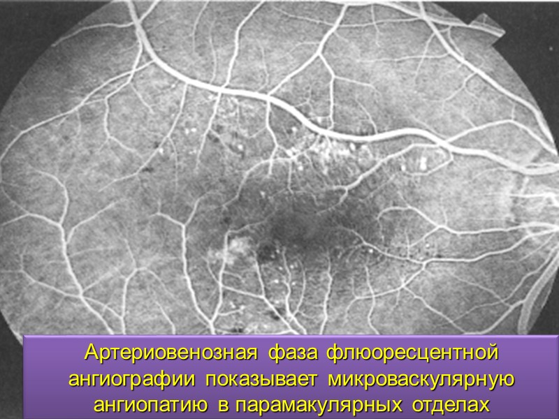 В России заболеваемость AMD составляет 15 человек на 1000 населения. Ожидается, что количество пациентов