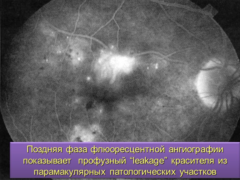 Избыточная инсоляция.     Ряд исследований указывает на связь между длительным и
