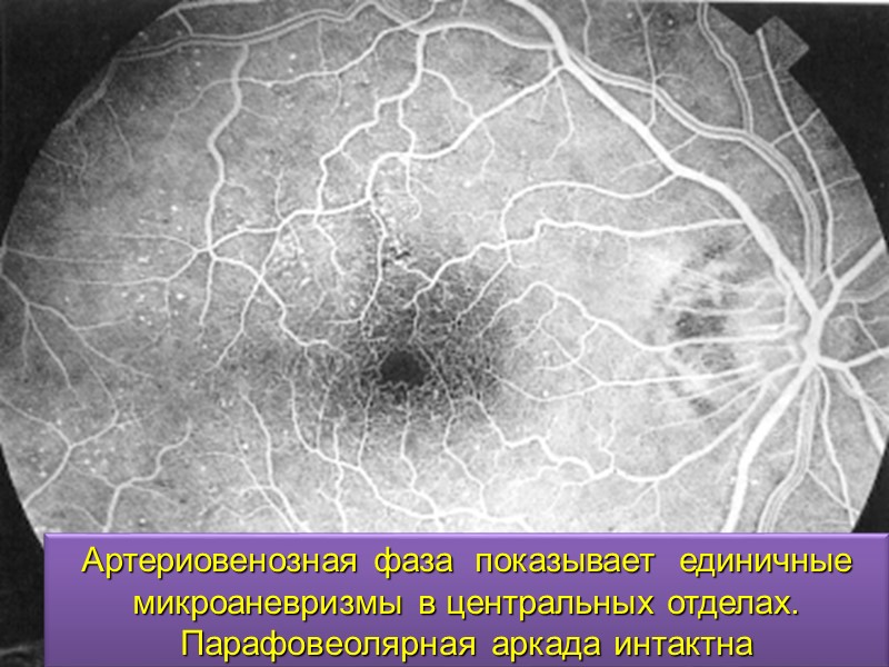 В план обследования пациентов с подозрением на AMD включается: Визометрия. Биомикроскопия переднего сегмента. Офтальмоскопия,