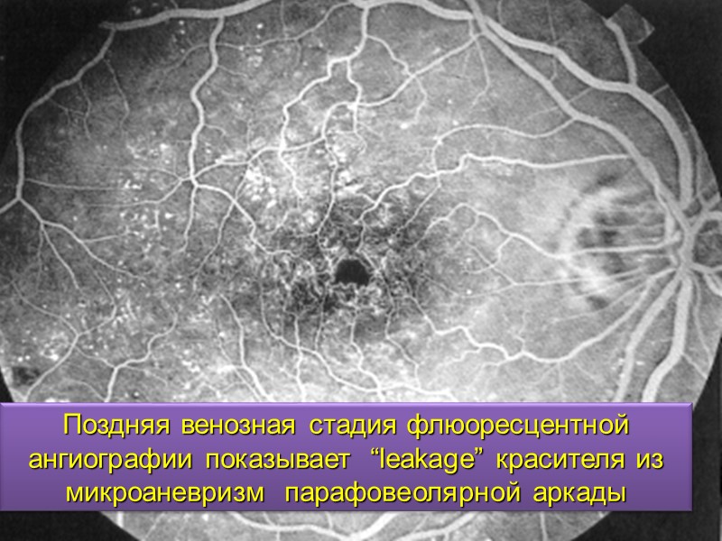 Классификация AMD.       Различают две формы AMD:  Неэкссудативная