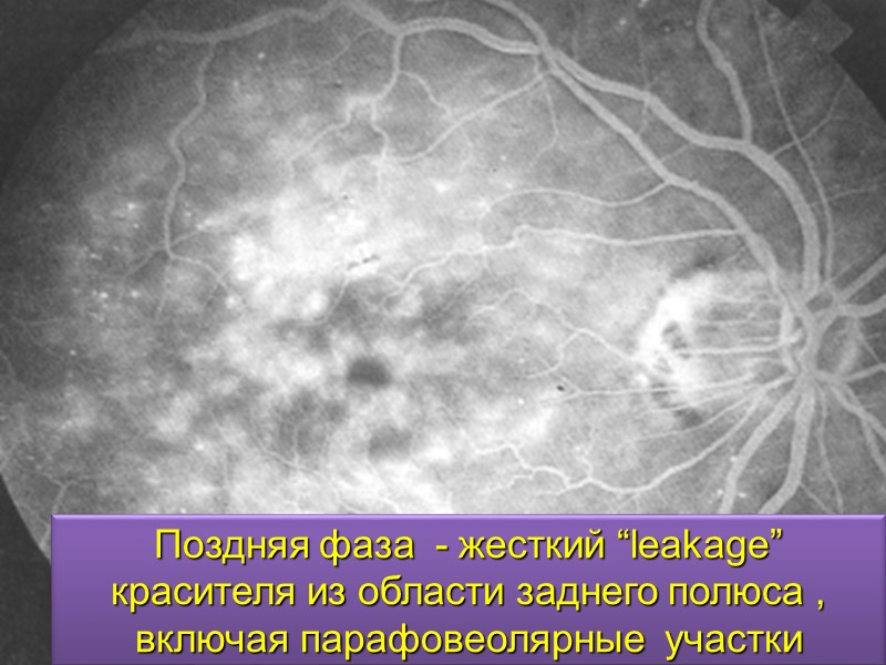 Неэкссудативная (сухая) форма. Друзы в макулярной зоне.  Перераспределение пигмента : гипер- или гипопигментация.