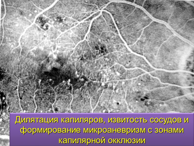 Ретинальные друзы.