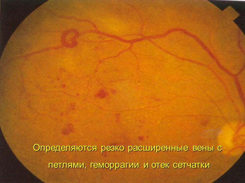 Географическая атрофия ПЭС.