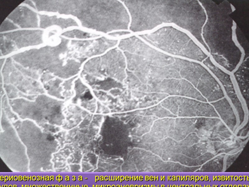 Географическая атрофия ПЭС.