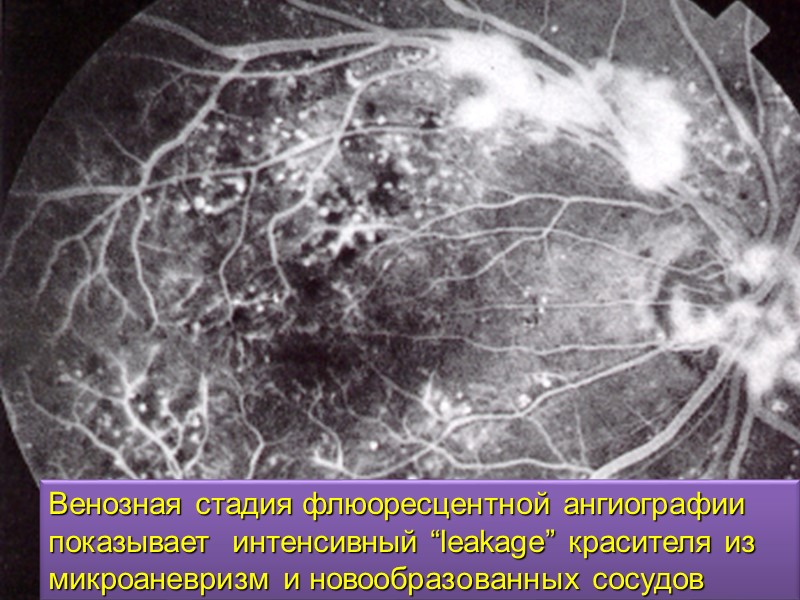 Новообразованные сосуды  проникают через мембрану Бруха и прорастают в субэпителиальное пространство Развитие субфовеальной