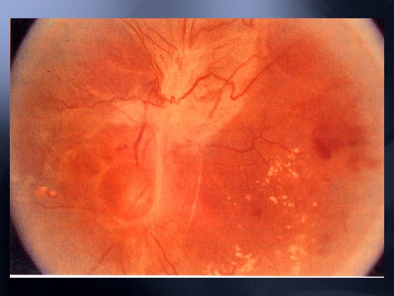 Новые сосуды продолжают расти под  ПЭ Друзы ресорбируются Развитие субфовеальной «влажной» сенильной макулодистрофии