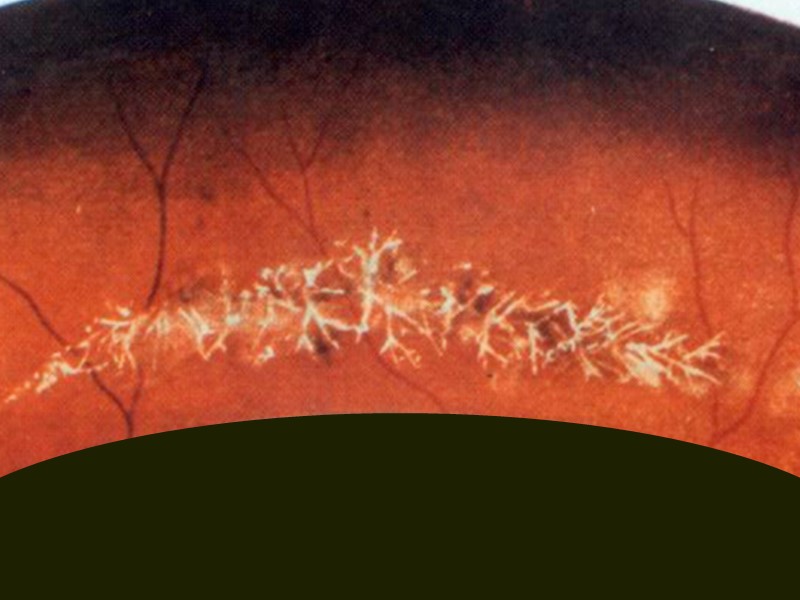 Нормальная макула      Следует обращать внимание на наличие фовелярного и