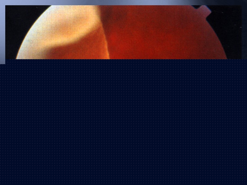 Острые сосудистые нарушения 1. Окклюзия центральной артерии      сетчатки. 