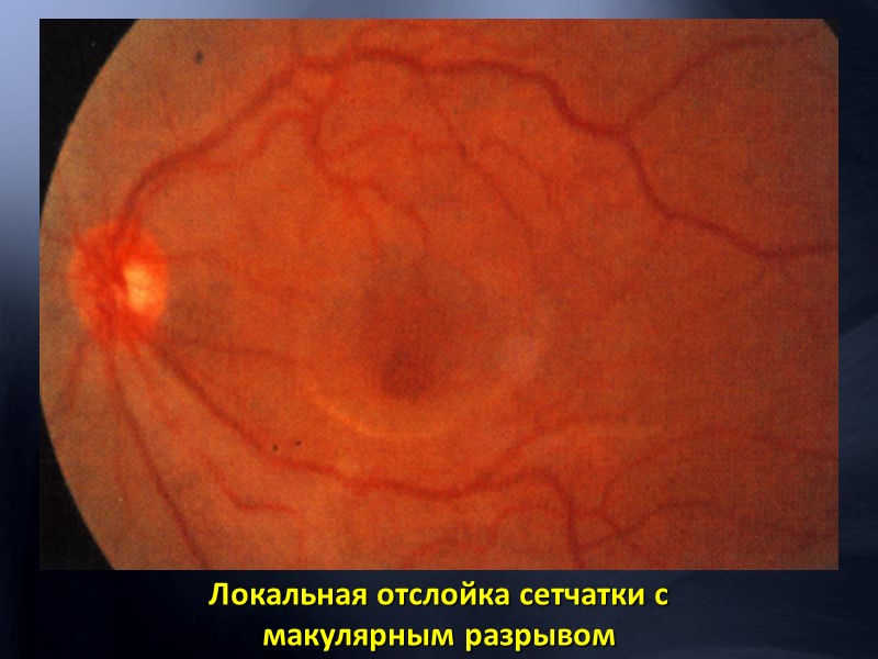 Представляет собой прекращение поступления крови через ЦАС, что вызывает ишемию внутренних слоёв сетчатки. 