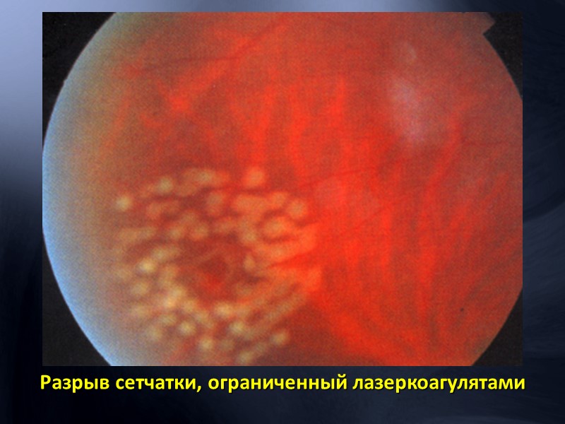 Фотография глазного  дна пациента с окклюзией ЦАС Симптом “вишневой косточки”