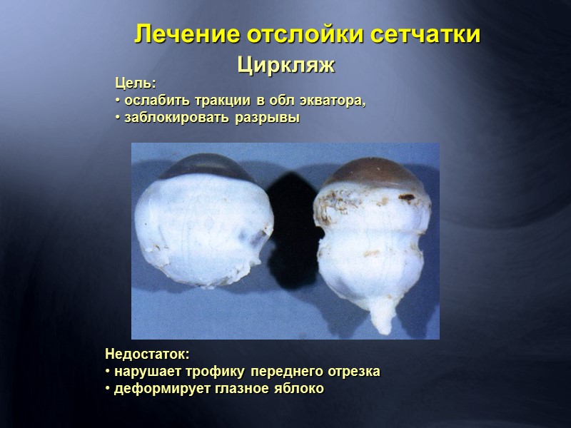 Окклюзия ветвей центральной артерии сетчатки