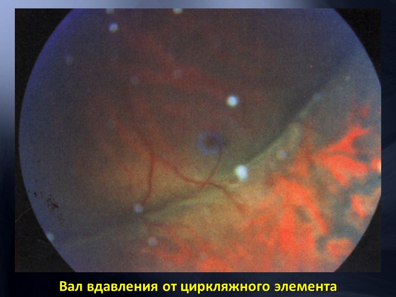 Отек сетчатки на фоне окклюзии ветви ЦАС