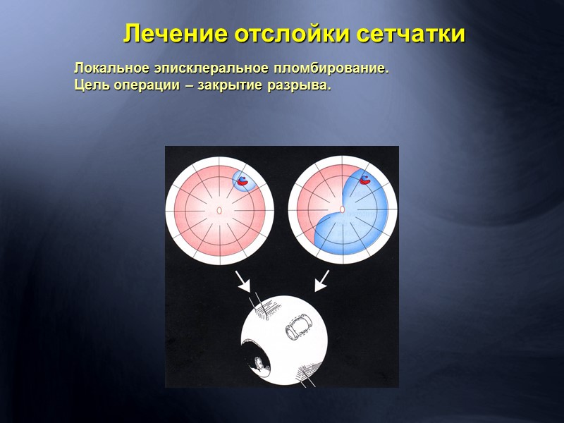 Оклюзия центральной артерии сетчатки. Цилиоретинальная артерия функциональна.