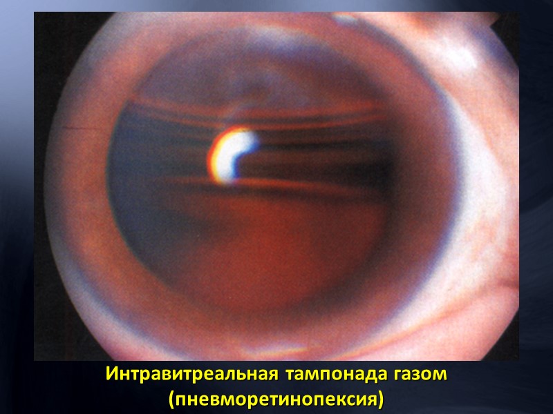 Фотография глазного дна и флюоресцентая ангиограмма, показывающая сохранность кровотока в центре сетчатки за счет