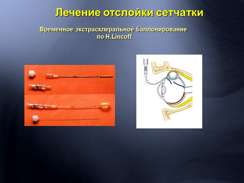 Оклюзия цилиоретинальной артерии.  1