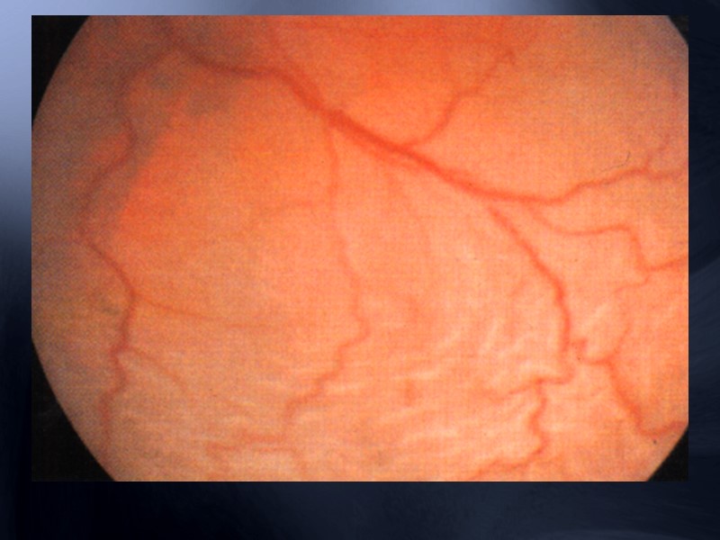 Лечение прогностически неблагоприятно    Принципы:   усиление оксигенации сетчатки (вдыхание карбогена)