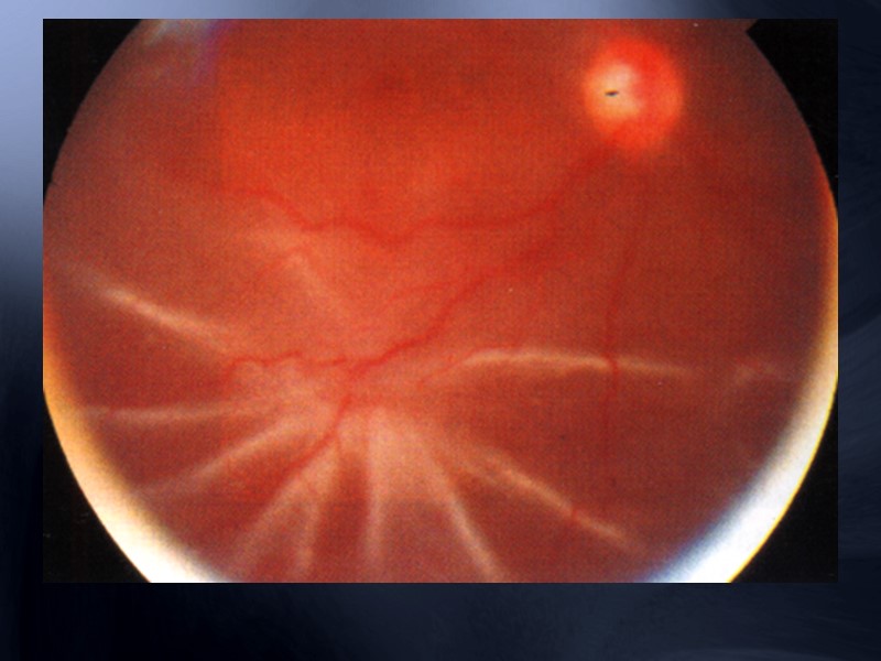 Лечение Предлагаемая схема:  Нитроглицерин 1 таб. под язык Эуфиллин 2,4% -10,0 мл в/в