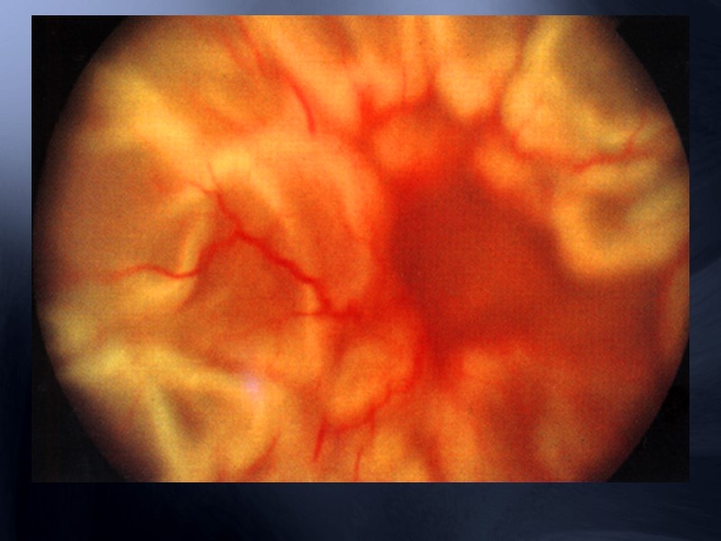 Анатомические предпосылки  канал в lamina cribrosa уже, чем в нерве  плотная структура