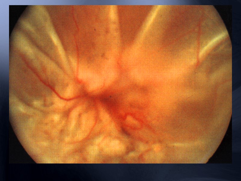 Картина « раздавленного помидора » Проявления: усиление венозного дерева, повышение извитости и расширение капилляров,