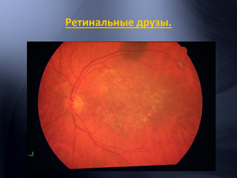 Тромбоз ветви центральной вены сетчатки в стадии разрешения