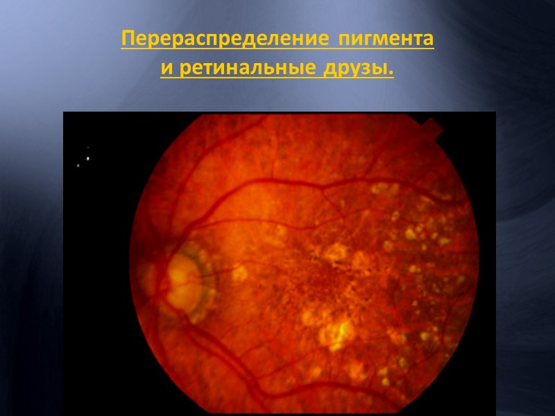 Явление  ретинальной неоваскуляризации после тромбоза ветви ЦВС