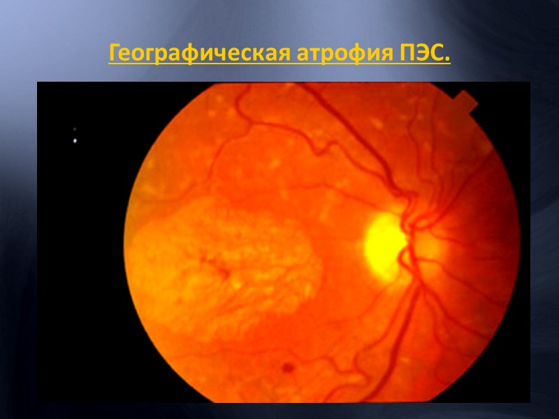 Посттромботическая ретинопатия Неоваскуляризация сетчатки Кистовидный и ишемический макулярный отек Неоваскуляризация радужки