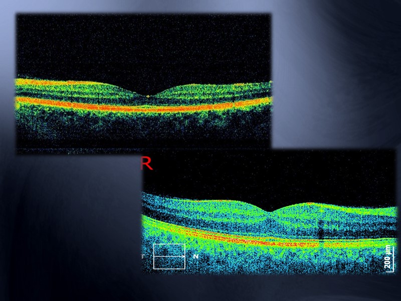 Лечение посттромботической ретинопатии эффективность медикаментозного лечения не доказана Неоваскуляризация сетчатки Гемофтальм Ar или диодная
