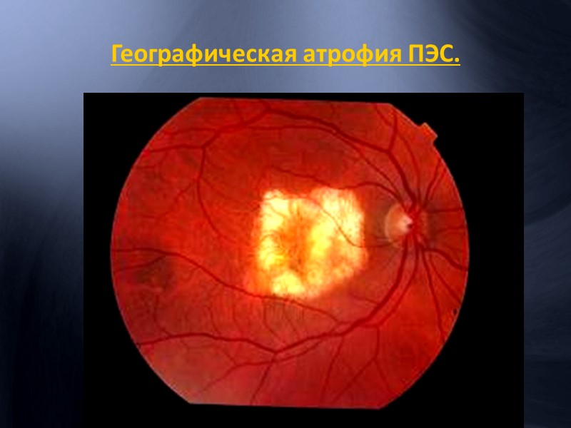 Ишемический макулярный отек Лечение посттромботической ретинопатии макулярный отек Кистовидный макулярный отек Обязательное проведение флюоресцентной