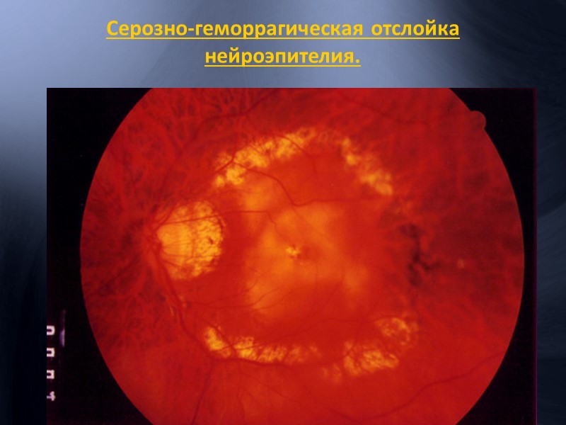 Основным агентом, ответственным за патологические изменения сетчатки является VEGF – vascular endothelial growth factor
