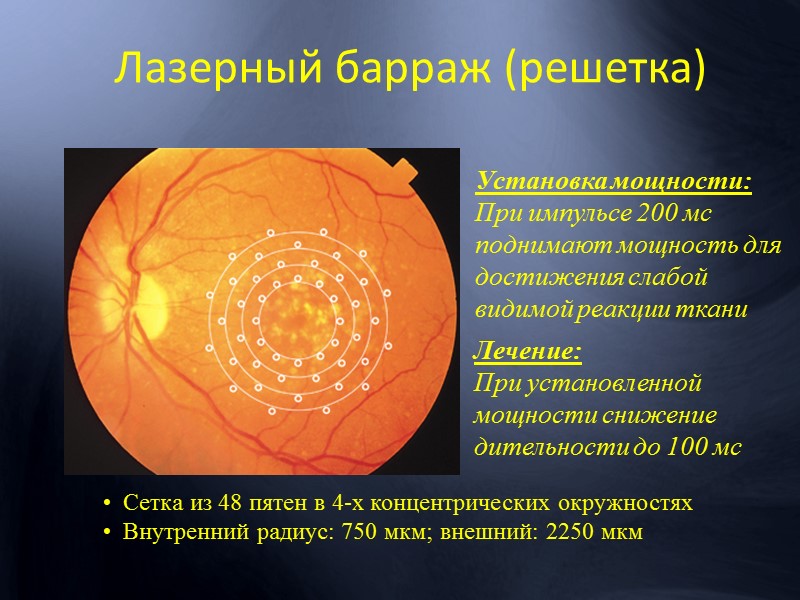 Диабетический макулярный отек (ДМО)